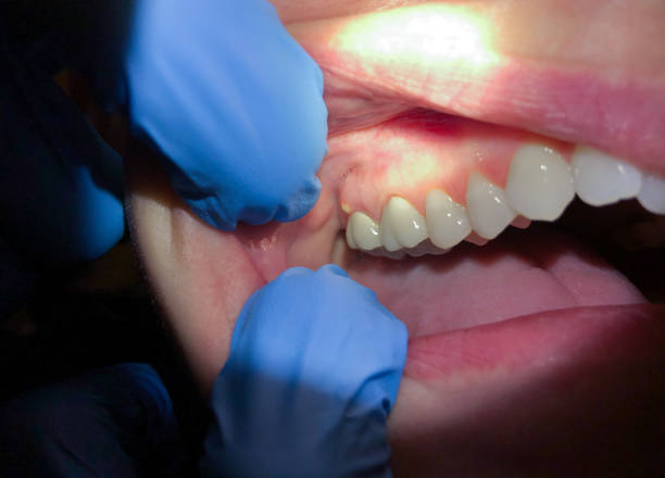 Best Emergency Wisdom Tooth Extraction in Cera, AL
